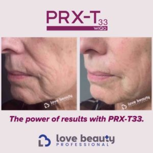 PRX-T33 before and after photo