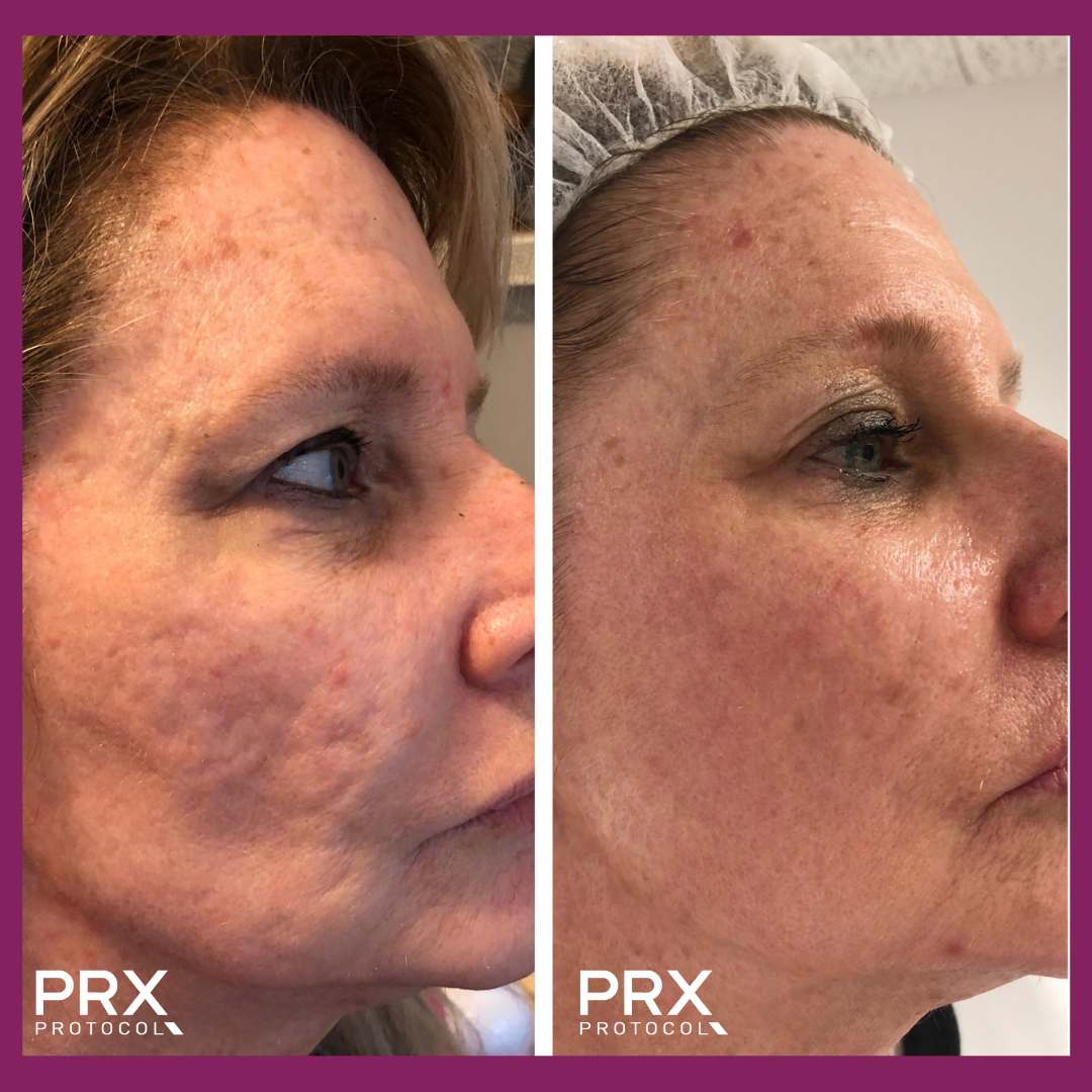 PRX Webinar: ‘SYNERGY IN ACTION’ Microneedling Protocol