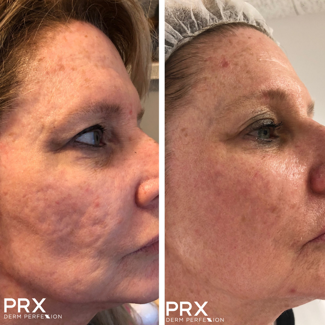 Hands-on Workshop: Microneedling + PRX-T33 DERM PERFEXION Advanced Combination Protocol (Woburn MA)