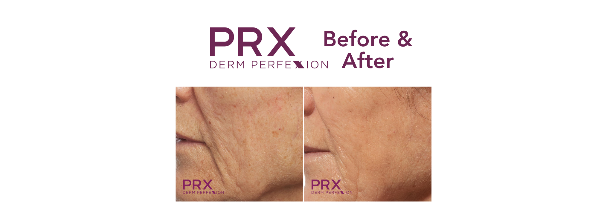 Discover the PRX Derm Perfexion Difference: PRX T33 Before and After